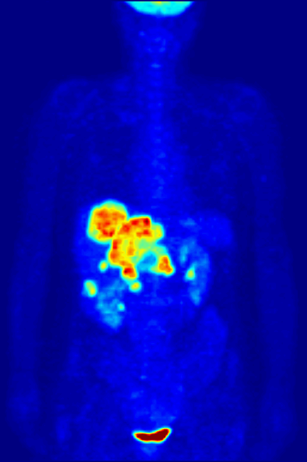 Tomografische Untersuchung zur Vorbereitung einer Strahlentherapie,
Quelle:https://de.wikipedia.org/wiki/Datei:PET-MIPS-anim.gif#/media/Datei:PET-MIPS-anim.gif