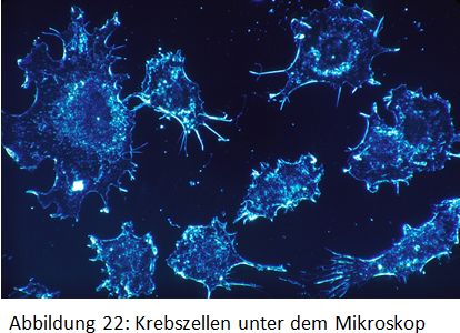 Krebszellen im Mikroskop, öffnen Sie dieses Bild in großer Version Krebszellen im Mikroskop